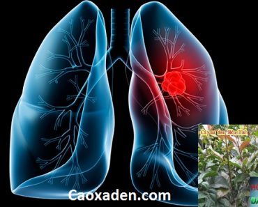 Bố bị ung thư phổi có dùng được cây xạ đen không ?