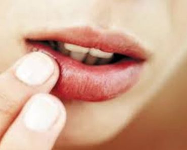 Bị nhiệt miệng dùng cây thuốc nào để điều trị hiệu quả ?