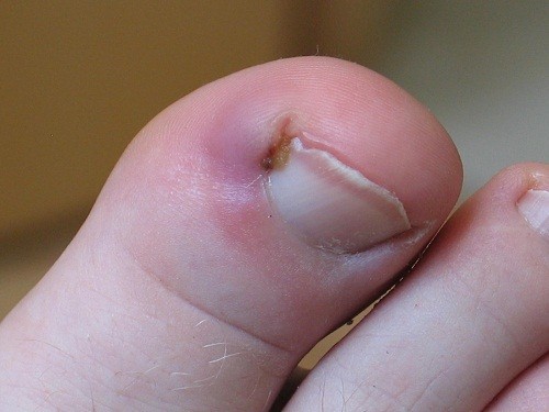 Chín mé ngón chân