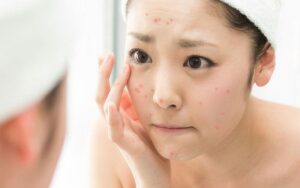 Nổi mụn tuổi dậy thì