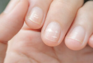 Móng tay có đốm trắng