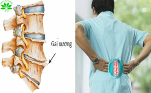 Gai cột sống